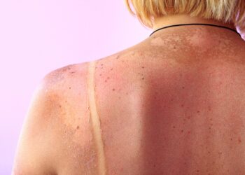 Sun Spots vs Skin Cancer: What’s the Difference?