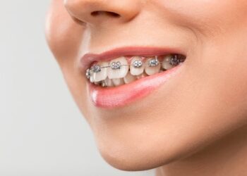 The Benefits of Silver Braces: Why They’re Not Just for Aesthetics