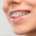 The Benefits of Silver Braces: Why They’re Not Just for Aesthetics
