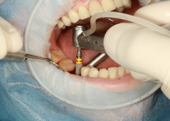 Why Choosing Affordable Teeth Implants Doesn’t Mean Sacrificing Quality