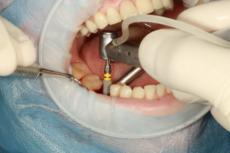 Why Choosing Affordable Teeth Implants Doesn’t Mean Sacrificing Quality