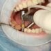 Why Choosing Affordable Teeth Implants Doesn’t Mean Sacrificing Quality