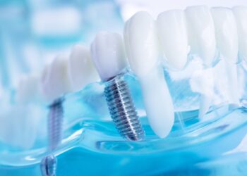 10 Qualities to Look for in the Best Dental Implant Dentist