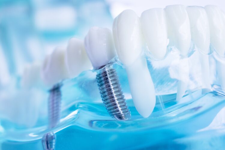 10 Qualities to Look for in the Best Dental Implant Dentist
