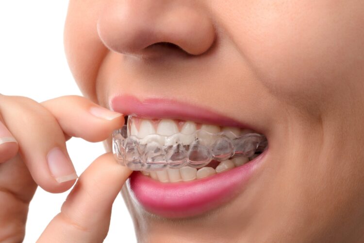 Debunking Myths About Invisalign for Adults: Separating Fact from Fiction