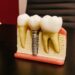 Breaking Down the Procedure: What to Expect During an Endosteal Implant Surgery