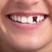 From Dentures to Implants: Comparing the Best Teeth Replacement Treatments