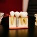 Smile Transformation: Understanding the Factors Influencing Full Mouth Reconstruction Cost