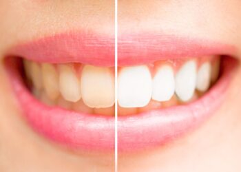 A Comprehensive Guide to Understanding Dental Whitening Price and Options