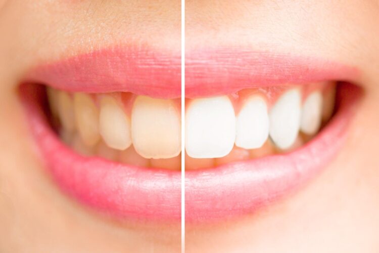 A Comprehensive Guide to Understanding Dental Whitening Price and Options