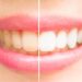A Comprehensive Guide to Understanding Dental Whitening Price and Options