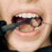 The Ultimate Guide on How to Prepare for Wisdom Teeth Removal