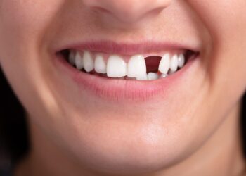 What to Do When You Have a Missing Tooth