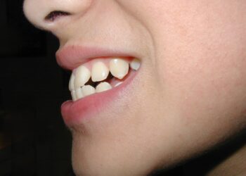 The Pros and Cons of Invisalign vs Braces for Overbite Treatment