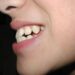 The Pros and Cons of Invisalign vs Braces for Overbite Treatment