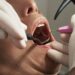 What Actually Happens During a Full Mouth Restoration